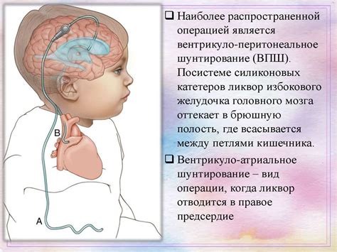 Влияние парной процедуры на организм при гидроцефалии