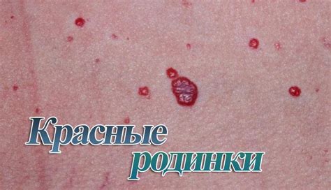 Влияние родинки на попе у мужчины