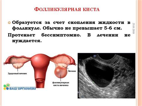 Мастодинон и киста яичника