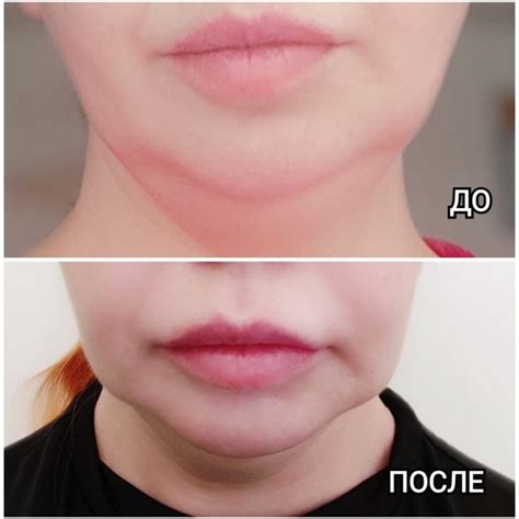 Обилие жировых отложений в области щек и подбородка