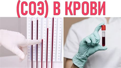 Повышенное уровень СОЭ как один из признаков наличия миомы
