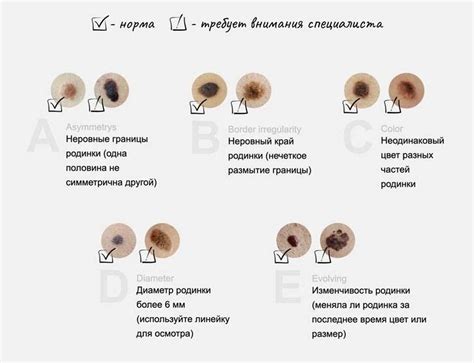 Символика родинок