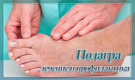 Что такое подагра и как она отличается от артрита