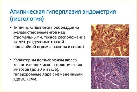  Характеристика гиперплазии эндометрия

